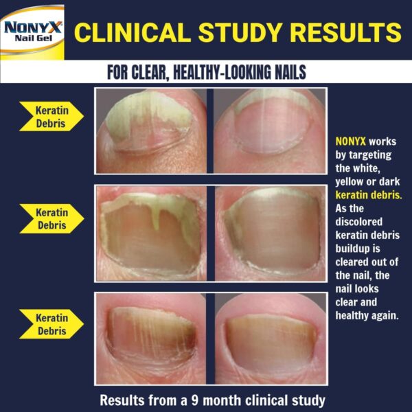 Nail Clarifying Gel | Clinically Proven for Discolored and Damaged Toenails | Restores the Appearance of Thick, Brittle, Yellow or Lifted Nails | Effective Nail Care Treatment | Made in the USA - Image 3