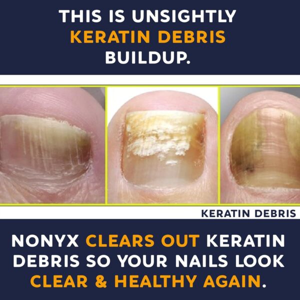 Nail Clarifying Gel | Clinically Proven for Discolored and Damaged Toenails | Restores the Appearance of Thick, Brittle, Yellow or Lifted Nails | Effective Nail Care Treatment | Made in the USA - Image 7