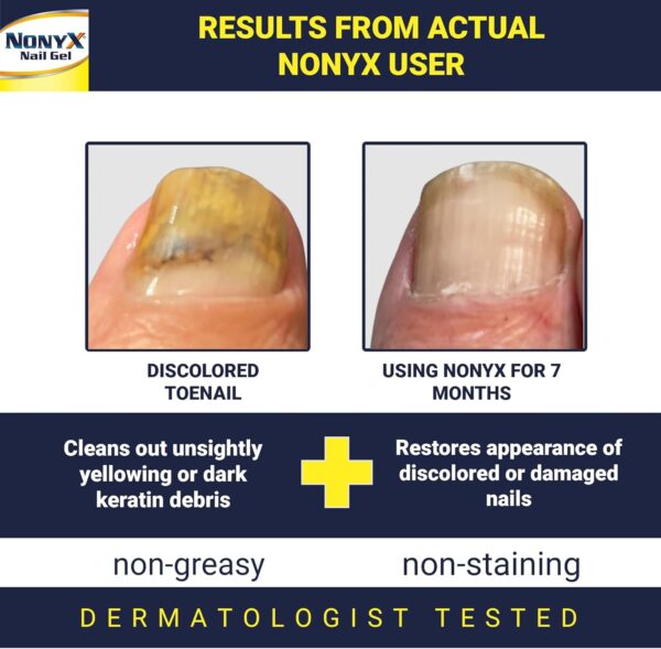 Nail Clarifying Gel | Clinically Proven for Discolored and Damaged Toenails | Restores the Appearance of Thick, Brittle, Yellow or Lifted Nails | Effective Nail Care Treatment | Made in the USA - Image 2