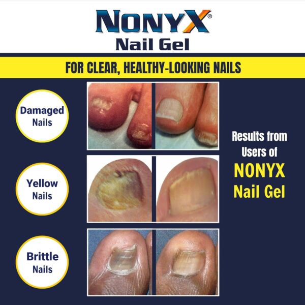 Nail Clarifying Gel | Clinically Proven for Discolored and Damaged Toenails | Restores the Appearance of Thick, Brittle, Yellow or Lifted Nails | Effective Nail Care Treatment | Made in the USA - Image 5